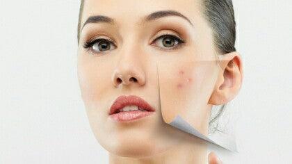 Natural Ways To Fade Blemishes | 6 Easy Remedies For Skin Blemishes  